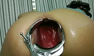 Speculum prolapse-a  ...